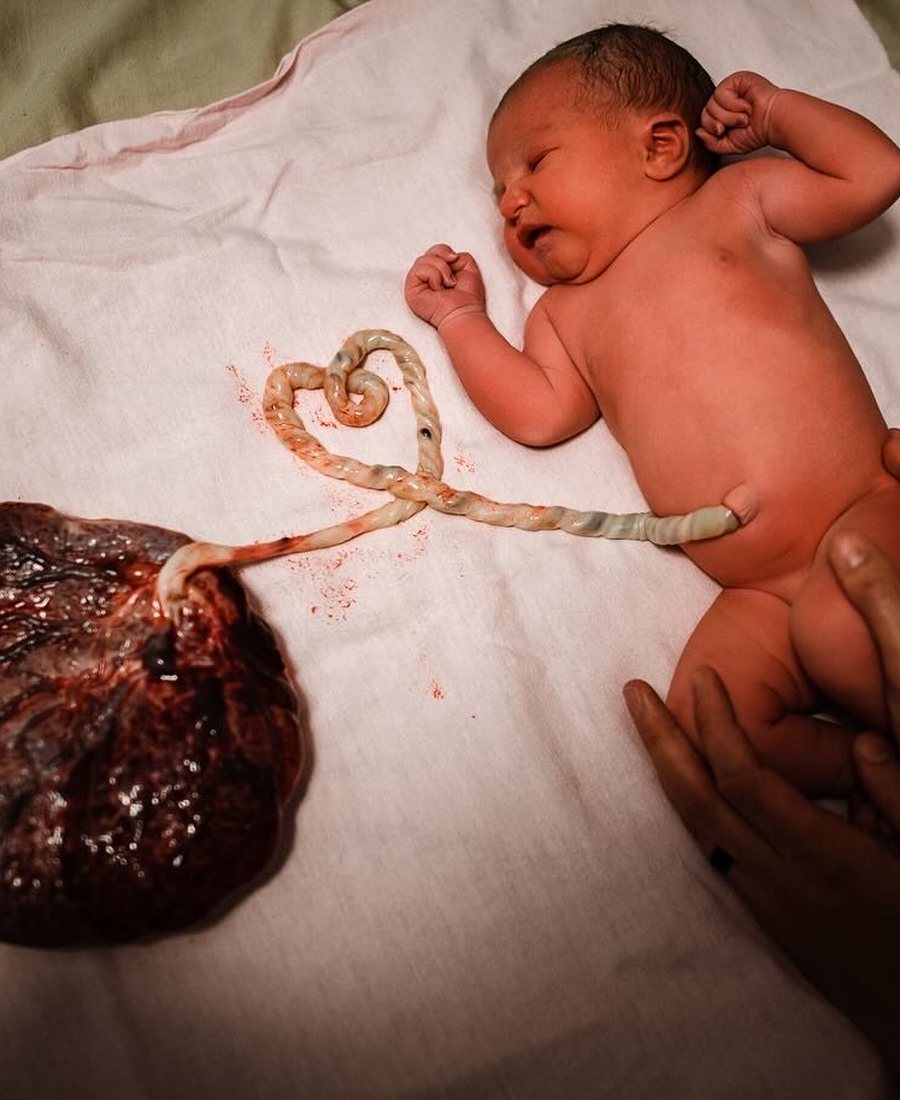 A newborn resting beside the placenta, the umbilical cord curled into a heart shape